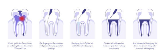 Ablauf Wurzelbehandlung, Zahnarzt Zürich, finest smile