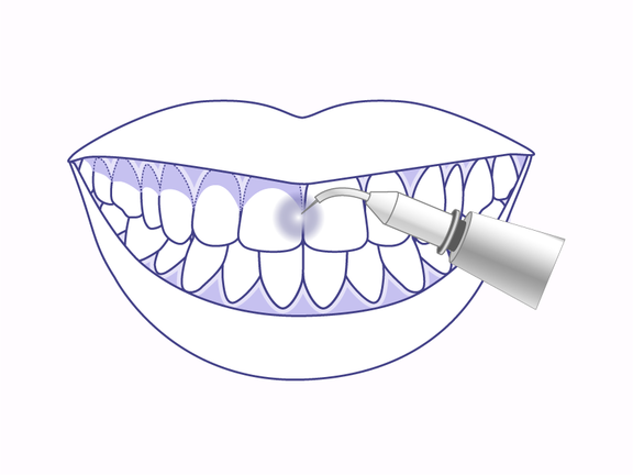 Gummy Smile Laserbehandlung, Zahnarzt Zürich, finest smile