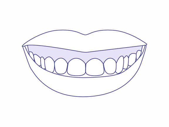 Gummy Smile Korrektur mit Veneers, Zahnarzt Zürich, finest smile