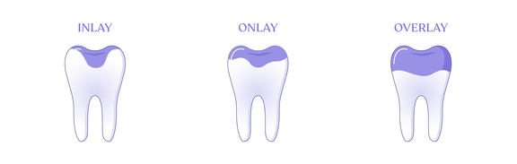 Inlay, Onlay, Overlay, Zahnarzt Zürich, finest smile