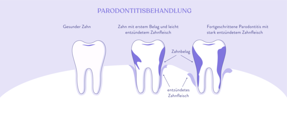 Parodontitisbehandlung, Zahnarzt Zürich, finest smile