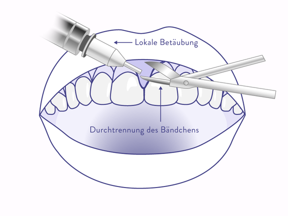 Gummy Smile Korrektur Lippenband, Zahnarzt Zürich, finest smile