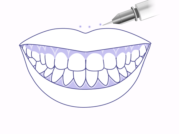 Gummy Smile Korrektur mit Btx, Zahnarzt Zürich, finest smile