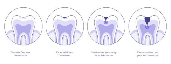 Auswirkungen unbehandelte Karies, Zahnarzt Zürich, finest smile