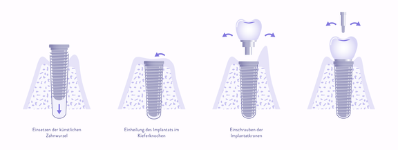 Ablauf Zahnimplantate, Zahnarzt Zürich, finest smile