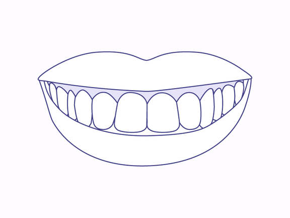 Gummy Smile Korrektur mit Veneers, Zahnarzt Zürich, finest smile